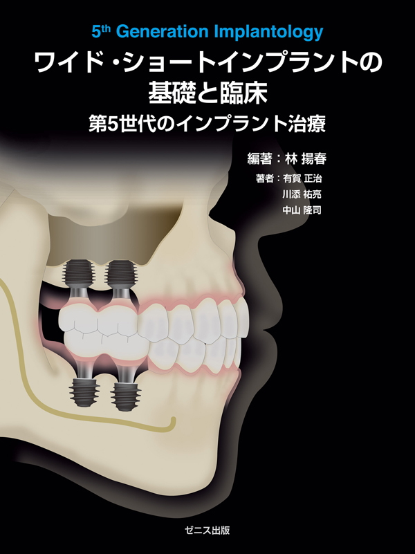 wideshort-implant